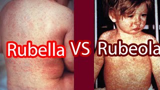 Rubella vs Rubeola Measles vs German Measles [upl. by Nylesor]