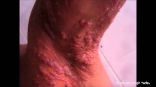 Classical Presentation Of Herpes Zoster amp Treatment [upl. by Ydeh]