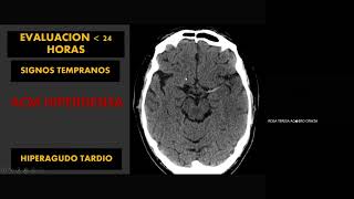 Evaluación Radiológica del Accidente Cerebro Vascular [upl. by Narcissus]