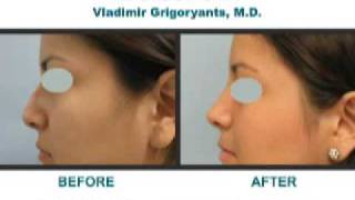 Los Angeles rhinoplasty Nose Job Beverly Hills Dr Vladimir Grigoryants reviews surgery [upl. by Hujsak]