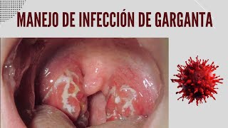 Manejo de la Infección y dolor de garganta [upl. by Ocirema]