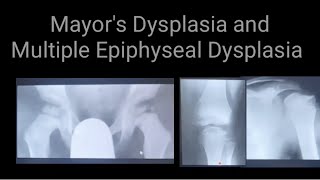 Mayors Dysplasia and Multiple Epiphyseal Dysplasia Radiology anx Xrays findings [upl. by Dermott]