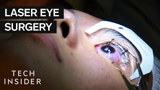 What Its Like To Get Laser Eye Surgery [upl. by Bunch]