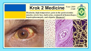 Krok 2 Medicine  Year 2019  045 Ministry of Public Health of Ukraine [upl. by Aitercal411]