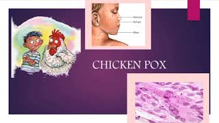 CHICKENPOX  Definition of chickenpox  Symptoms of chickenpox💯 [upl. by Cassella]