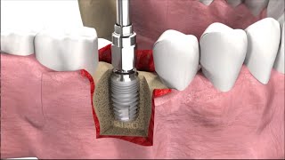 Имплантация зубов виды техника операции и цены [upl. by Lak]