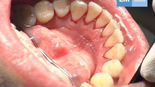 Periodontal treatment protocol [upl. by Iana]