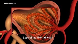 3D Animation Fokal segmental glomerulosklerose FSGS [upl. by Colin505]