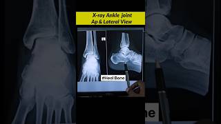 Fracture Heel Bone Calcaneal Bone Xray Ankle radiographerusn Xray Fracture bones shorts [upl. by Amaleta518]