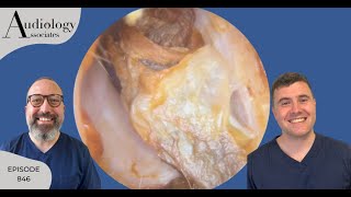 ITCHY EAR CANALS FIXED amp ANTERIOR RECESS EAR WAX REMOVAL  EP846 [upl. by Cheria]