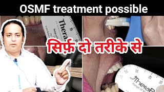 OSMF ऐसे ठीक करें 100 आराम होगा ही OSMF treatment in India। [upl. by Atteynek]