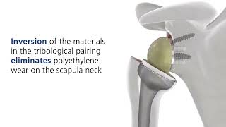 Mathys Features and benefits of an Affinis Inverse reverse shoulder prosthesis [upl. by Ayadahs958]