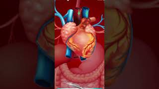 How Does Heart Bypass Surgery Work Coronary Artery Bypass Graft Procedure Animation CABG Video [upl. by Slater]