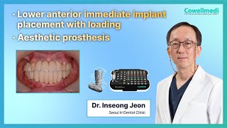 Lower anterior immediate implant placement with loadingBy DrInseong Jeon [upl. by Tanny]