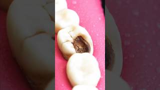 Tooth cavity  RCT  RCT step by step  dentaldoubts passiondentistry dentist toothloss [upl. by Anetta]