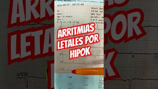 Porqué ocurren arritmias por HipoKalemia⁉️🫀 [upl. by Aneet]