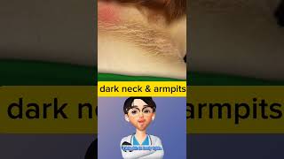 Dark neck and armpits than the rest of your body  Doctor explains acanthosis nigricans idoctor [upl. by Lraep]