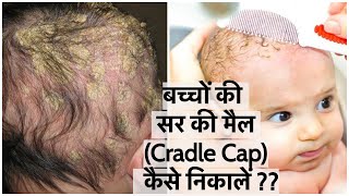 बच्चों की सर की मैल कैसे Cradle Cap निकालें  How to Remove Cradle Cap  Easy amp Effective way [upl. by Hcurab]