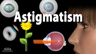 Astigmatism Types Causes Symptoms and Treatment Options Animation [upl. by Gautious415]