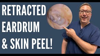 EAR WAX REMOVAL RETRACTED EARDRUM AND SKIN REMOVAL  EP455 [upl. by Nedra]