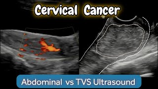 Cervical Cancer  Mass   TVS vs Abdominal Ultrasound  Risk Factors [upl. by Audris]