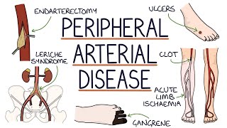 Understanding Peripheral Arterial Disease [upl. by Seaddon652]