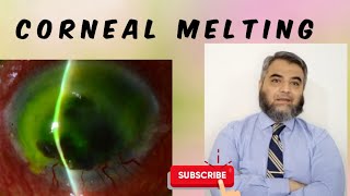 CORNEAL MELTING [upl. by Enneira]