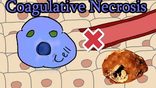 Coagulative Necrosis  Animation [upl. by Kcirtap]