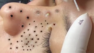 Big Cystic Acne Blackheads Extraction Blackheads amp Milia Whiteheads Removal Pimple Popping  6638 [upl. by Silvie]