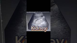 Small Kidney  cortical Thinning  Renal parenchymal Disease on Ultrasound [upl. by Monda]