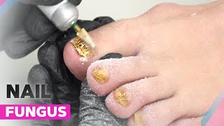 Onychomycosis  How to Deal with Nail Fungus [upl. by Kathy]