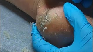 Pedicure  6 mins Podiatry Look at cracked heels Dead skin removal and Cracked heels treatment [upl. by Mali761]