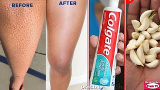 Get Rid of Strawberry Legs in One Day  Get Rid of Keratosis Pilaris amp Dark Spots On Legs Naturally [upl. by Negriv623]