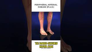 Claudication In Legs Symptoms  Claudication  Leg Pain  Dr Gaurav Gangwani [upl. by Rosdniw471]