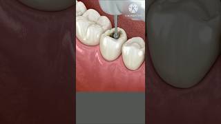 Dental Restoration ↪ Composite Bonding Teeth ↪shortssarjaryanimationshorts3dvideo [upl. by Selfridge]