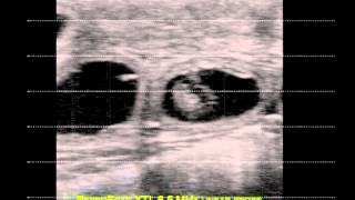 38 day pregnancy test with ReproScan XTL 65 MHz linear probe [upl. by Ahsiya273]