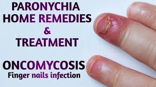 Paronychia Home remedies  Finger nail infection  skin infections  paronychia  finger infection [upl. by Anivad]