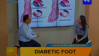 Good Morning Kuya Diabetic Foot Syndrome [upl. by Dragoon]