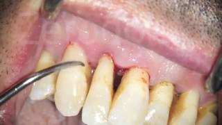 Scaling Treatment  Teeth scaling and Root Planing procedure DeepCleaning [upl. by Landel]