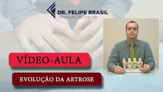 VÍDEO AULA  ARTROSE DO JOELHO [upl. by Eelaroc]