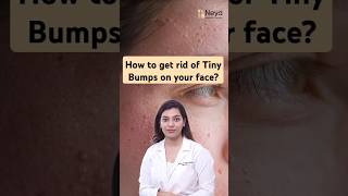 What is Milia on the face  How to treat milia  Dermatologist in Hyderabad [upl. by Ecnahc]