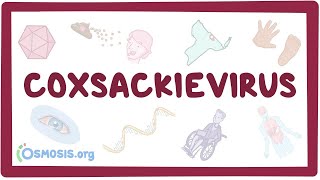 Coxsackievirus  an Osmosis Preview [upl. by Angele]