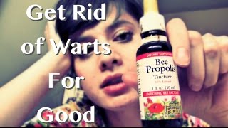 How To Get Rid of Warts  A Natural CHEAP Solution Bee Propolis [upl. by Him]