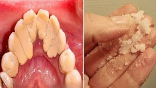 How to Get Rid of Plaque  Home Remedies for Plaque and Tartar [upl. by Zerla]