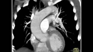 4D Imaging of the Aortic Valve Dilated aortic root 1 of 6 [upl. by Stearns]