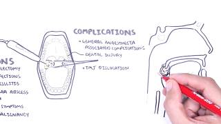 Acute Tonsillitis  causes viral bacterial pathophysiology treatment tonsillectomy [upl. by Sibby]