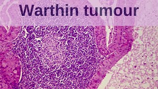 Warthin Tumour  Pathology mini tutorial [upl. by Irovi]