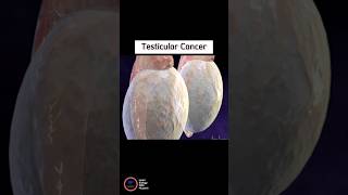 Human testicles Cancer A Guide to Testicular Cancer Diagnosis and Treatment [upl. by Seilenna]