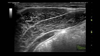 Contracción del transverso abdominal [upl. by Norvin]