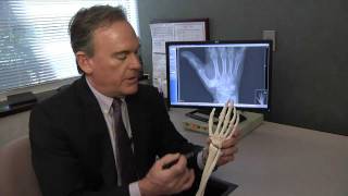 Treating Basal Thumb Joint Arthritis  Mayo Clinic [upl. by Ennaecarg]